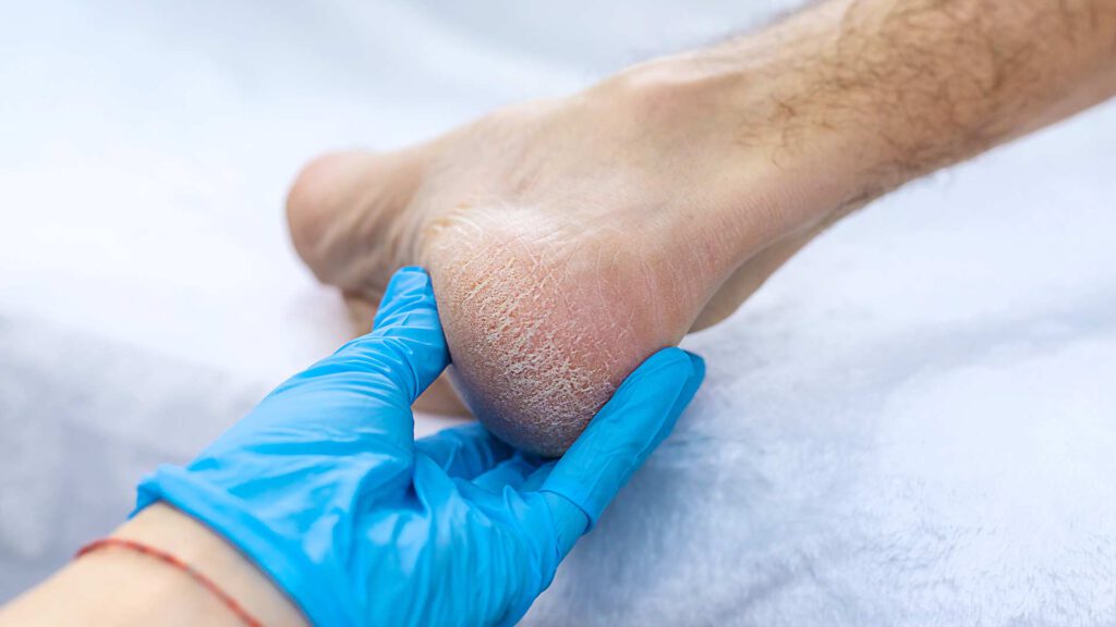 טיפול בעור קשה ועור סדוק ויבש